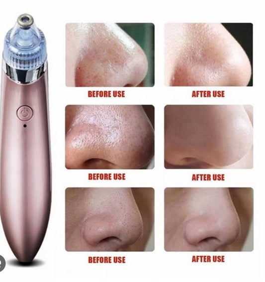 DermaClean Pro™ - Extractor de Puntos Negros y Espinillas